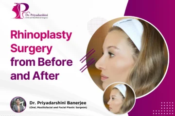 Rhinoplasty Surgery from Before and After