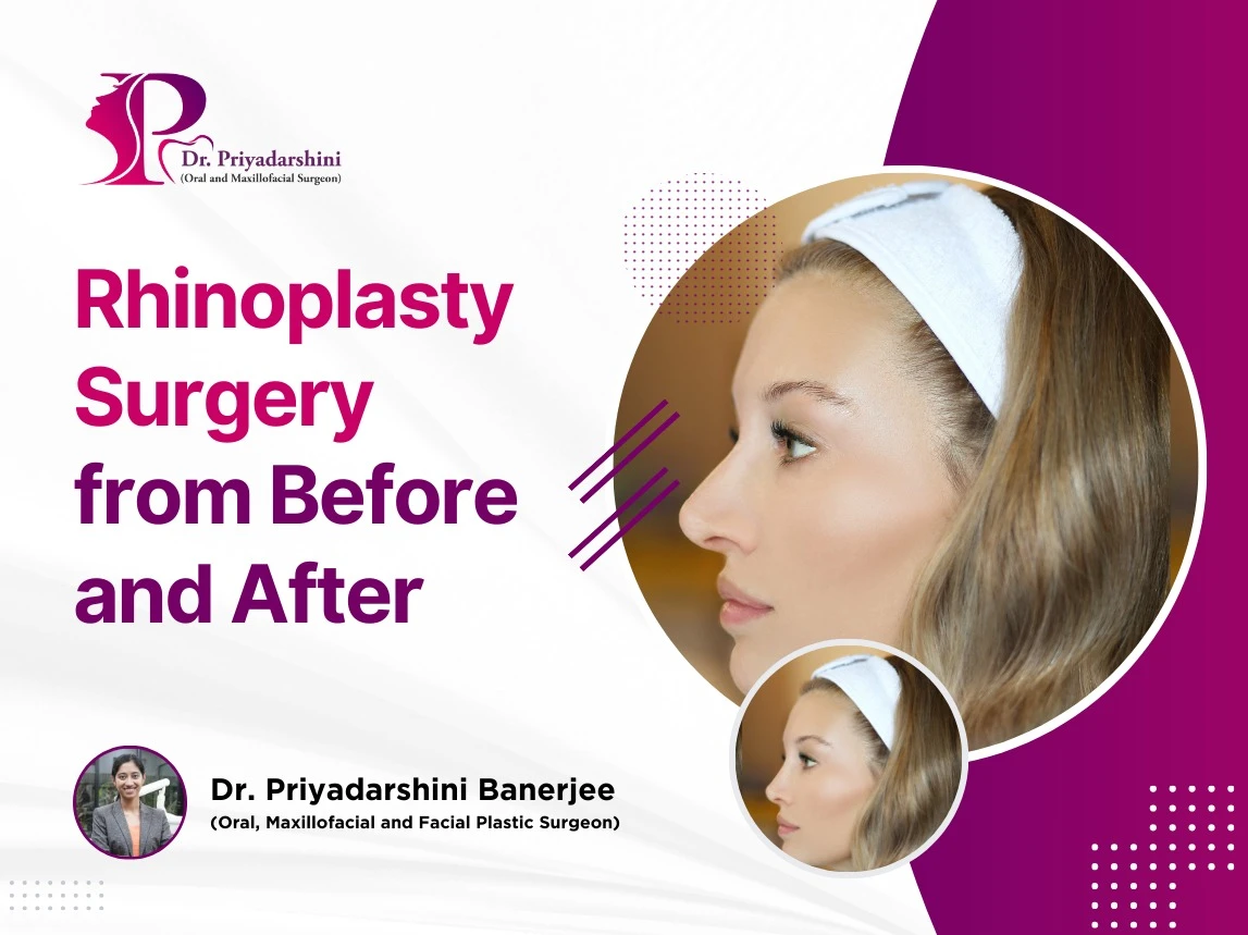 Rhinoplasty Surgery from Before and After