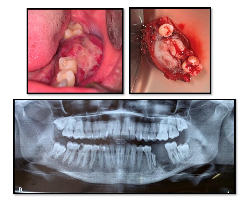 Cyst &Tumors (Giant cell Granuloma)