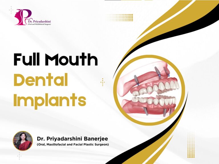 Full Mouth Dental Implants