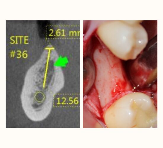 Implant-Ridge split