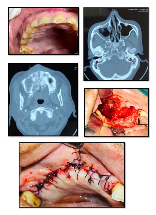 Mucormycosis