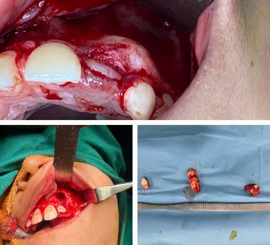 Unerupted tooth