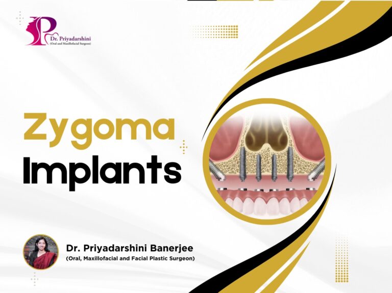 Zygoma Implants