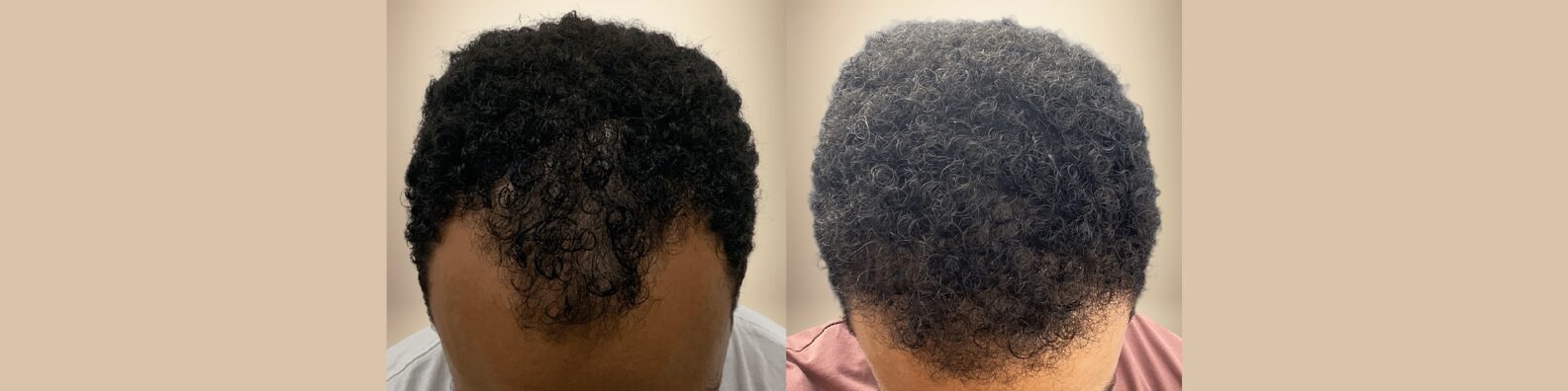 Afro Hair Transplant