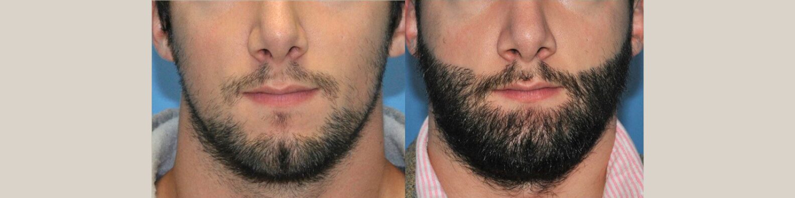 Beard Hair Transplant
