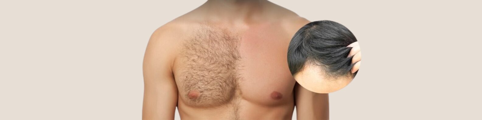 Body Hair Transplant