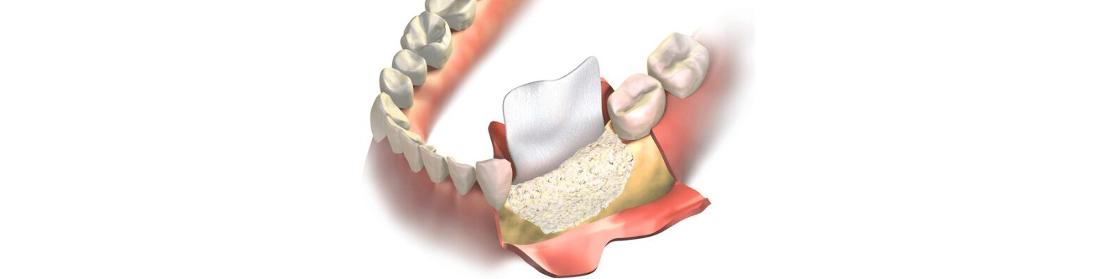 Bone Grafting​