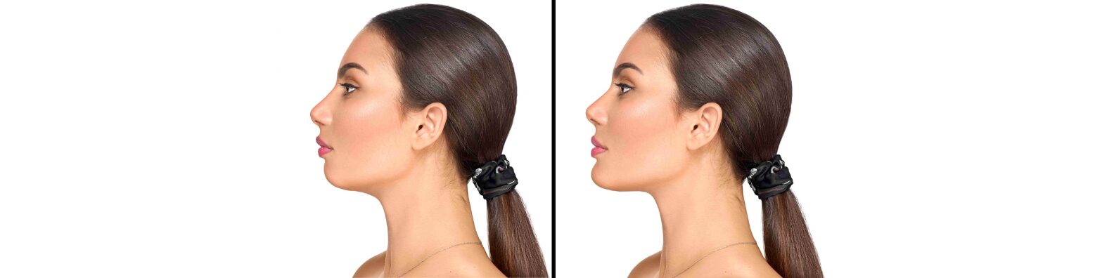 Chin and Jawline Augmentation