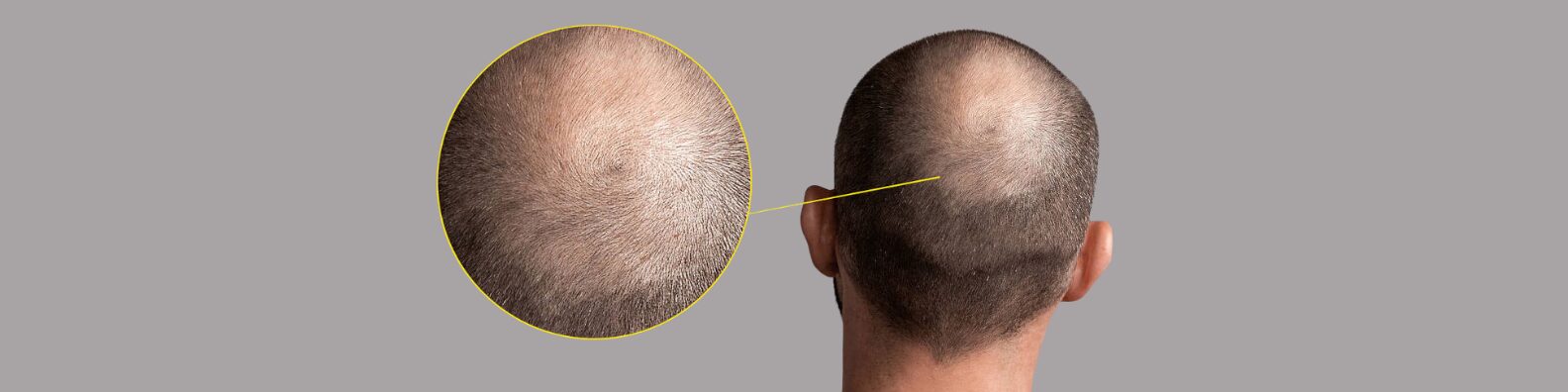Crown Hair Transplant