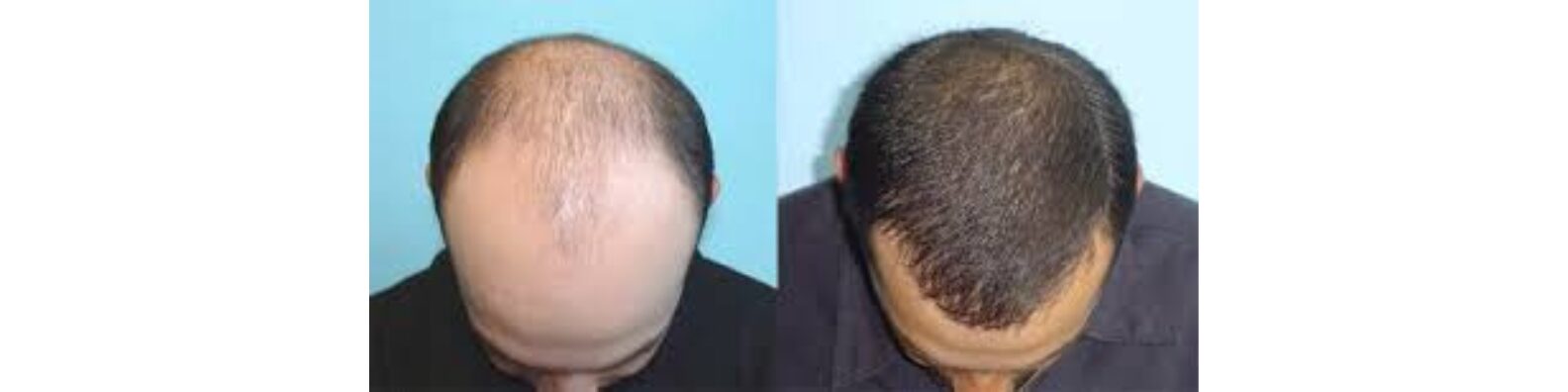 FUE Hair Transplant
