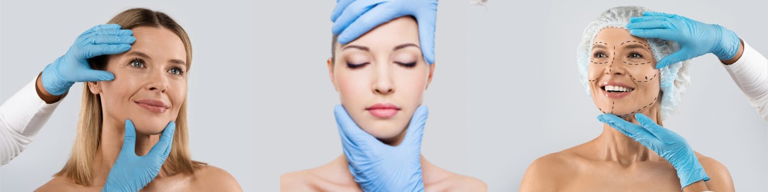 Facelift (Rhytidectomy)