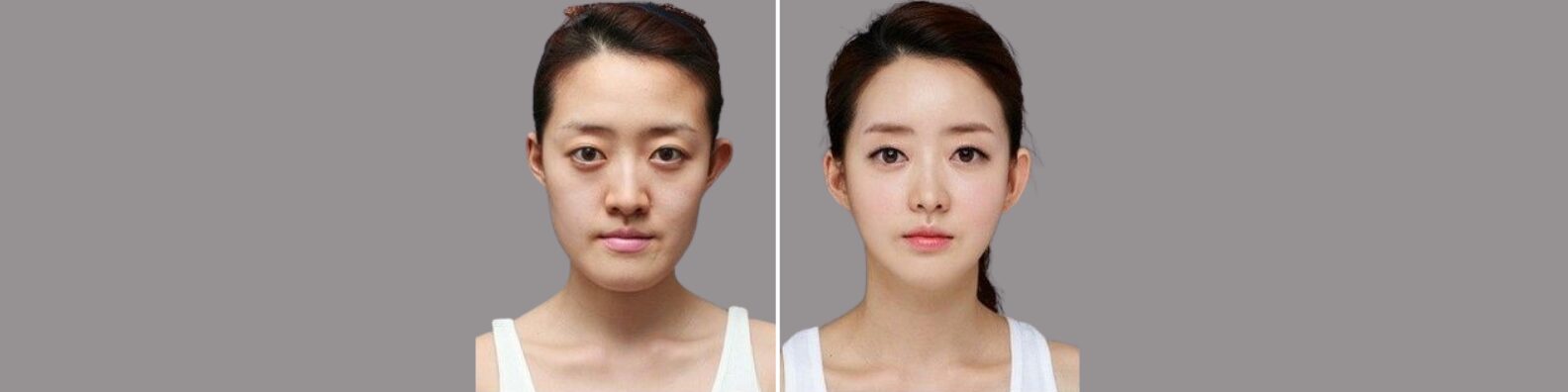 Facial Reconstruction