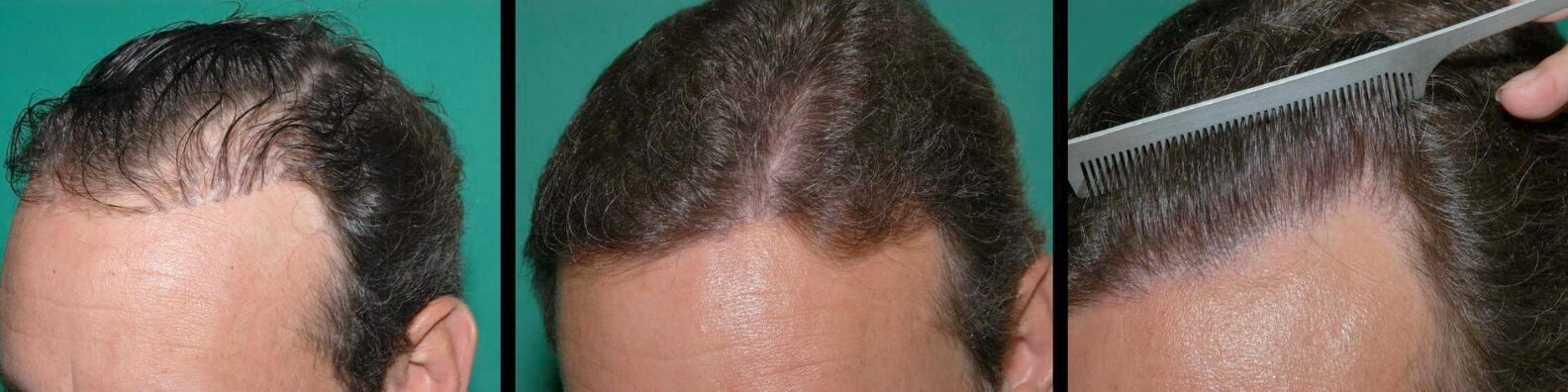 Hair Transplant Repair