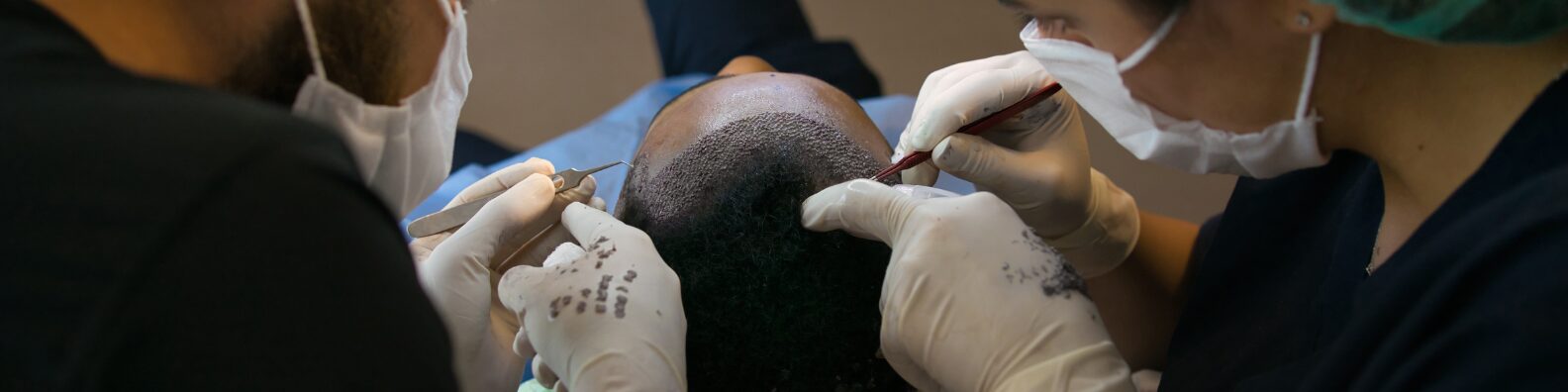 Hair Transplant