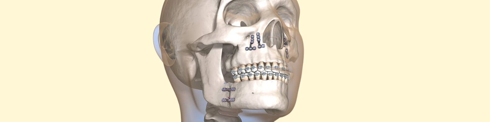 Jaw Surgery (Orthognathic Surgery)