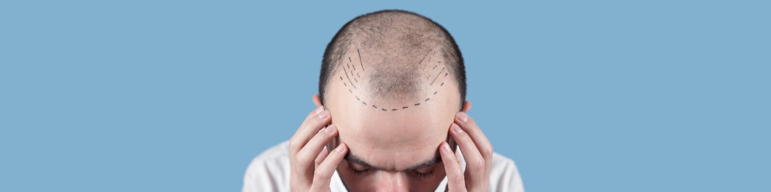 Male Hair Transplant