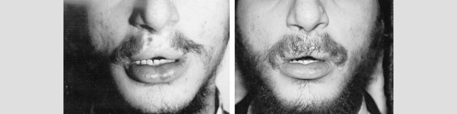 Moustache Hair Transplant