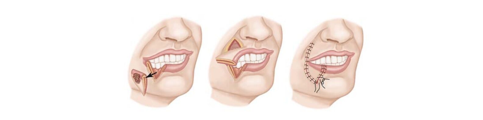 Oral Cancer Surgery