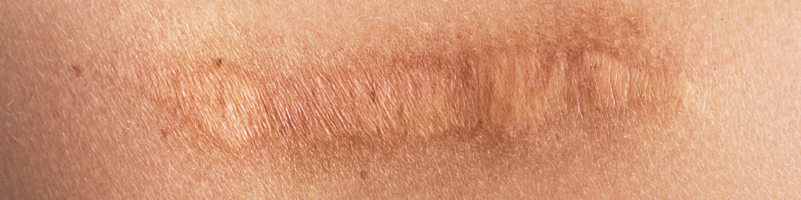 Scar Revision Surgery