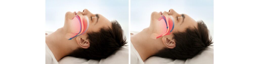 Sleep Apnea Surgery