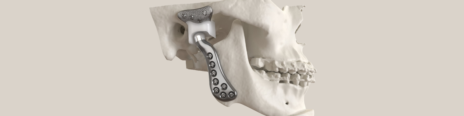 TMJ (Temporomandibular Joint) Surgery
