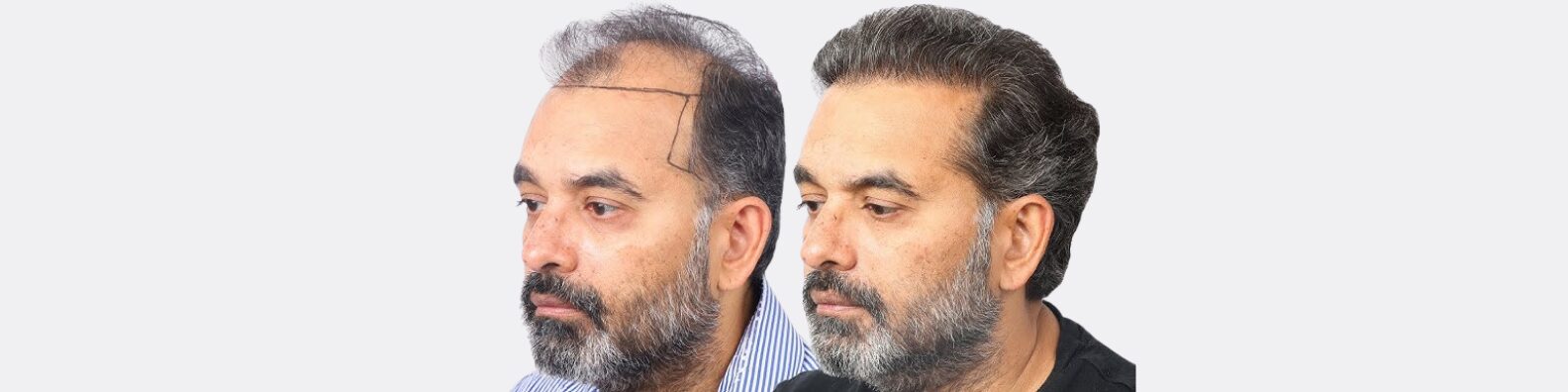 Temple Hair Transplant