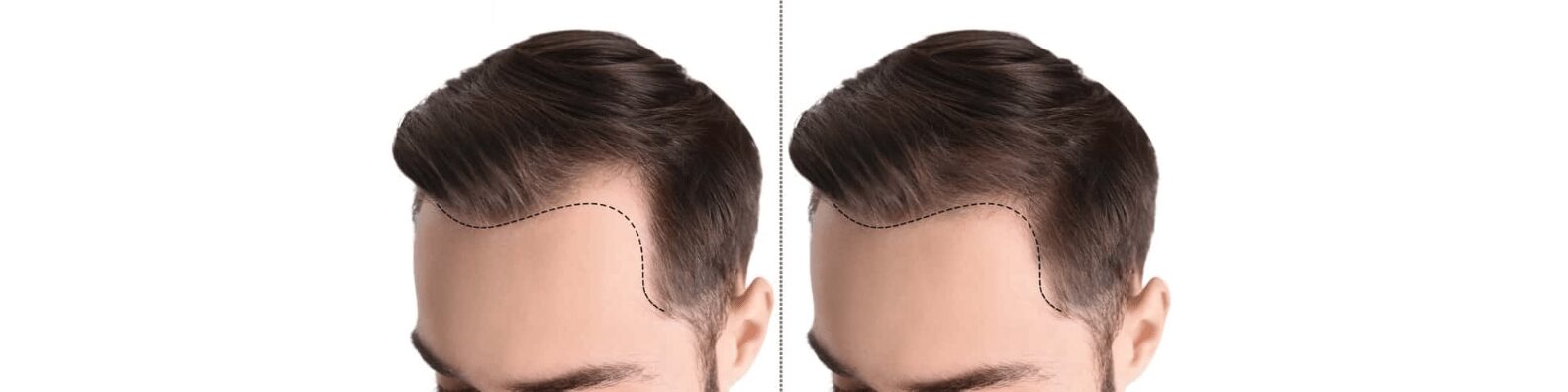 Unshaven Hair Transplant